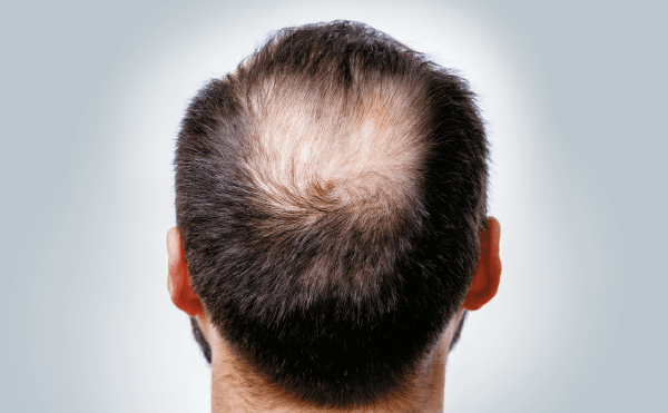 Growth Factors and Stem Cells to solve Hair Loss and Hair Thinning