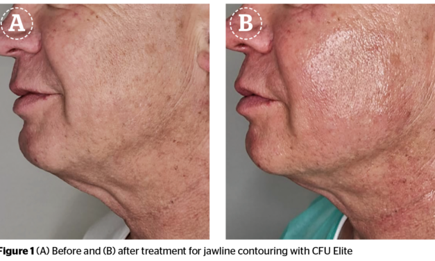 A non-invasive approach for jawline contouring