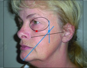 Figure 3 Central cheek injection point