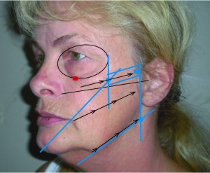 Figure 5 Mid-face 3D vectoring