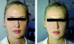 Figure 6 (left) Before and (right) after. 0.6 ml monophasic highly cohesive hyaluronic acid filler