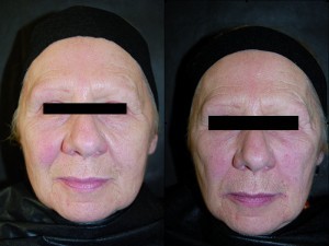 Figure 7 Round face before (left) and after (right). 2.0 ml monophasic cross-linked hyaluronic acid with a high proportion of low-molecular-weight short chains, plus 1.0 ml standard hyaluronic acid
