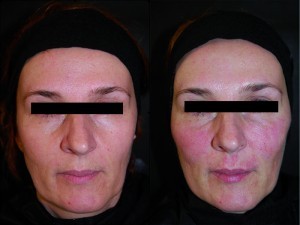 Figure 5 Triangular face (left) before and (right) after. 2.0 ml monophasic highly cohesive filler that consists of cross-linked hyaluronic with low-molecular-weight 
