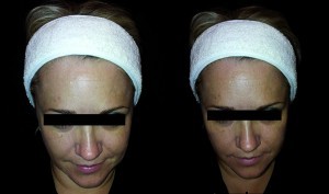 Figure 8 Before (left) and after (right). 1.0 ml monophasic highly cohesive filler consisting of cross-linked hyaluronic acid with a high proportion of low-molecular-weight short chains