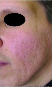 Figure 1a. Severe acne scars before treatment