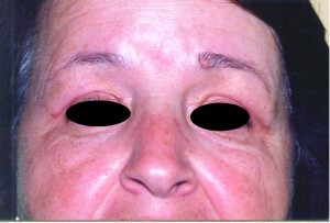 Figure 1b. Hyperpigmentation of blepharoplasty incisions after treatment