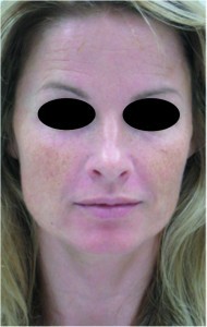 Figure 2a. Female patient, aged 42 years, showing the first signs of ageing. Before treatment