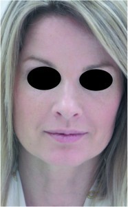 Figure 2b. Female patient, aged 42 years, showing the first signs of ageing. After two INTRAcel treatment sessions