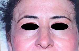 Figure 2b. After laser blepharoplasty of the upper eyelids and skin resurfacing of the lower lids
