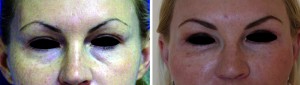 Figure 2 Non-surgical tear trough correction, (left) before and (right) after treatment
