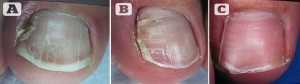 Figure 2 Before and after surgery for ingrown toenail. (A) Ingrown hallux nail before surgery (B) 3 months after surgery (C) The toe 1 year after surgery