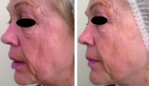 Figure 5 62-year-old female (left) before treatment and (right) after six treatment sessions. A significant improvement in skin laxity in the lower face and a reduction of wrinkles can be seen