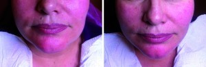 Figure 5 Treatment to the chin. (left) after one side has been treated and (right) after treatment to both sides