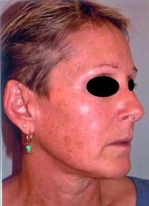 Figure 2a. Patient before treatment with a medium depth peel