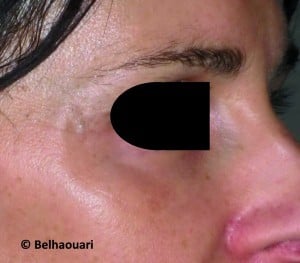 Figure 7. After treatment with hyaluronic acid to the tear trough