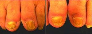 Figure 1 (left) Patient prior to  treatment and (right) after five sessions 3 weeks apart with two passes of a 1450 nm 10 J laser