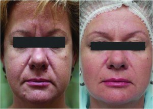 Figure 4 Optimal programme for the female patient (left) before and (right) after 3 months of the two stages treatment: 4 ml of hyaluronic acid filler of high cohesivity and viscosity, 0.8 ml medium cohesive filler, and 20 units of botulinum toxin A