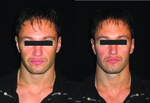 Figure 6 Optimal programme for the male patient (left) before and (right) after volumetric correction with 4 ml of monophasic highly cohesive hyaluronic acid filler