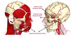 Figure 3 Location of the temporal and deep temporal arteries
