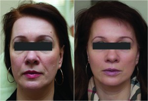 Figure 2 Minimum programme for the female patient (A) before and (B) after 2 ml monophasic high cohesivity and viscosity hyaluronic acid filler in mid-face, 0.8 ml of hyaluronic acid of medium viscosity in nasolabial foldes, marionettes, and lips