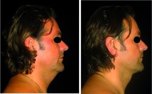 Figure 3. 43-year-old male patient (left) before and (right) after liposculpture of the neck and jowl line