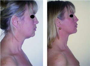 Figure 1. 38-year-old female (left) before and (right) 2 months after treatment