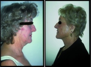 Figure 2. 76-year-old patient (left) before and (right) 1-year post-treatment