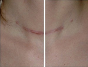 Figure 1 Fresh surgical scar (left) 4 weeks and (right) 4 months after initial surgery