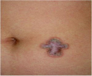 Figure 2 Hypertrophic scar formation after tattoo removal in a Fitzpatrick Skin Type III patient with history of excessive scar formation