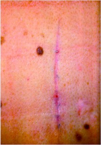 Figure 3c Resulting in inconspicuous scars (2 months post-surgery;)