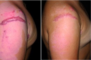 Figure 4 Pressure garments represent a promising means in treating excessive scarring, demonstrating convincing results (particularly in children). (left) before treatment and (right) result after 4 months (12 hours per day)
