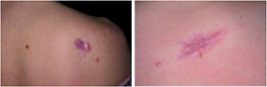 Figure 5 Commonly observed side-effects with intralesional steroids, such as (left) dermal atrophy and (right) telangiectasia