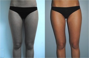 Figure 4 Localised adipocity and early cellulite in a 28-year-old female patient (left). Results after eight treatments, anterior view (right)