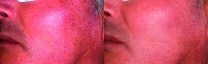 Figure 2 Phototype III, 60-year-old man with couperose on cheeks, nose and chin, as well as large telangiectasia (left). The Nd:YAG laser was used during the first session with 85 J, 15 ms, the 2.5 mm handpiece and a Peltier cooler. The second session took place 1 month later with the FT pulsed light system, with only one application with a 500 nm filter, 15 J, 8 ms (right) 