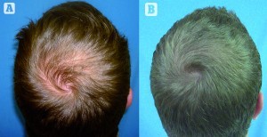 Figure 2 (A) Before and (B) 8 months after one session of platelet-rich plasma treatment