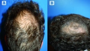 Figure 4 (A) Before and (B) 9 months after two platelet-rich plasma sessions