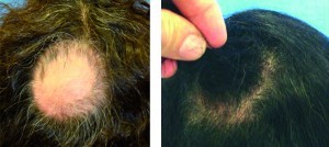 Figure 5 (left) Before and (right) 12 months after one platelet-rich plasma treatment session for alopecia areata