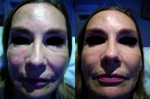 (left) Before and (right) after treatment with platelet‑rich plasma