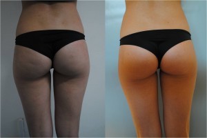 Figure 5 Localised adipocity and early cellulite in a 28-year-old female patient (left). Results after eight treatment, posterior view (right)