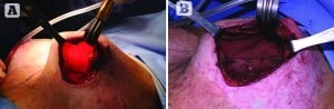 Figure 2 (A) Intraoperative, the pectoral muscle has retracted superiorly, the skin flap is thin. (B) Intraoperative, after scoring the capsule, a TIGR® mesh scaffold is placed in the pocket