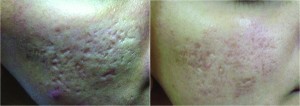 Figure 1 Active acne and acne scar (left) before and (right) after three treatments with microneedle radiofrequency