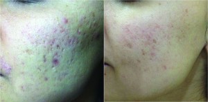 Figure 2 Active acne and acne scar (left) before and (right) after three treatments with microneedle radiofrequency