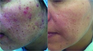 Figure 3 Active acne and acne scar (left) before and (right) after three treatments with microneedle radiofrequency