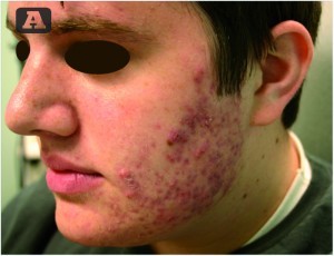 Figure 1a Before blue light treatment for inflammatory acne vulgaris