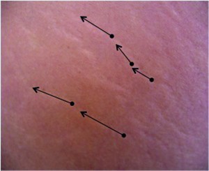Figure 6 Detachment lines for stretch marks treatment 