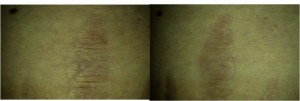 Figure 7 Stretch marks in a 44-year-old patient (left). Results after eight treatments (right)
