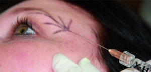 Figure 3 Supraorbital dermal filler injection with a cannula, to enhance hollowness and the brow