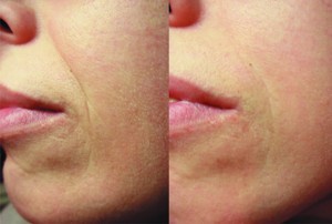 Figure 3 (left) before and (right) 60 days after 4th Pellevé treatment 