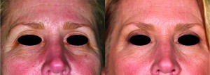 Figure 1 (left) before and (right) 30 days after 8th Pellevé treatment 