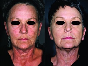 Figure 2 (left) before and (right) after 3rd Pellevé treatment
